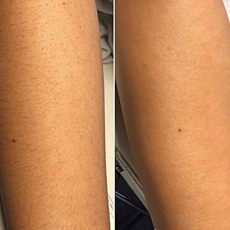 TrisCAM-prej-potem-1